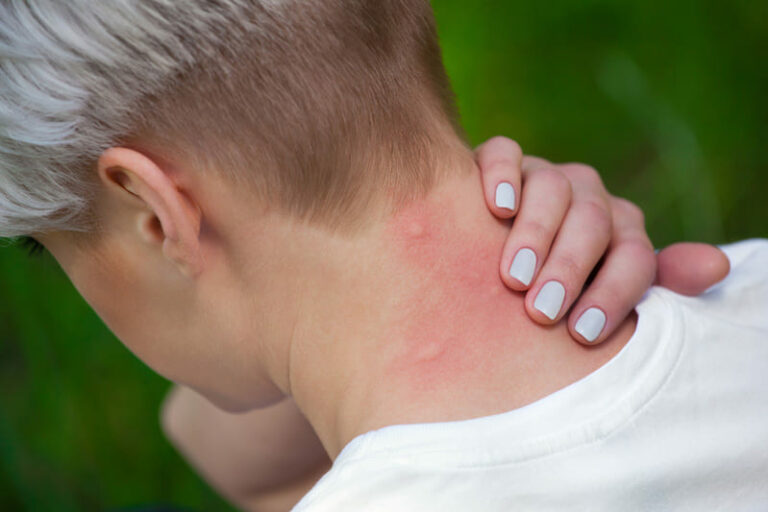 Alergia a las chinches: síntomas y tratamientos efectivos
