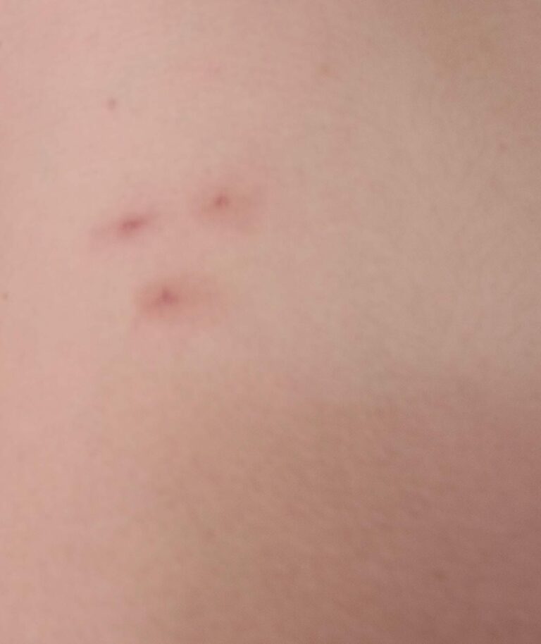 Cómo saber si me pica una pulga o una chinche: Guía fácil
