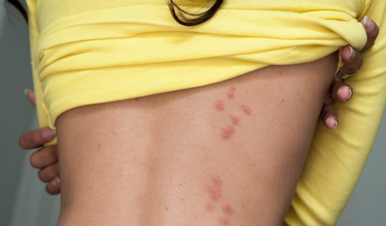 Como se pegan las chinches a las superficies: Descubre cómo