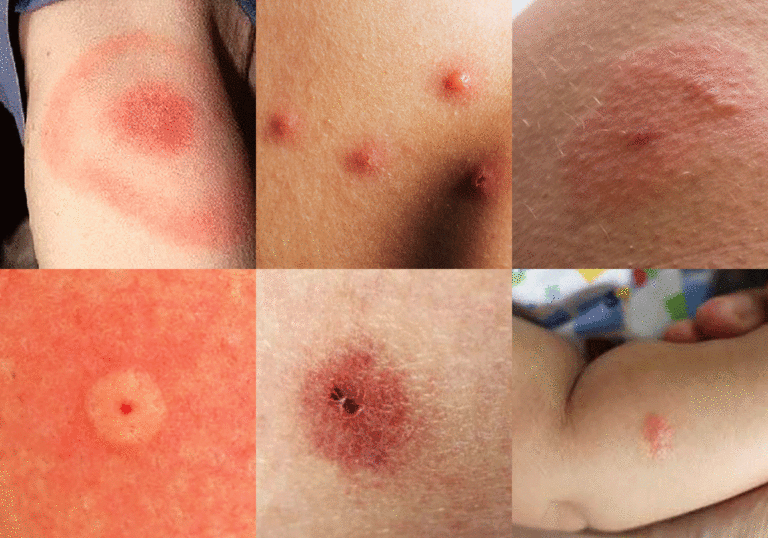 Como son las picaduras de los chinches: guía completa