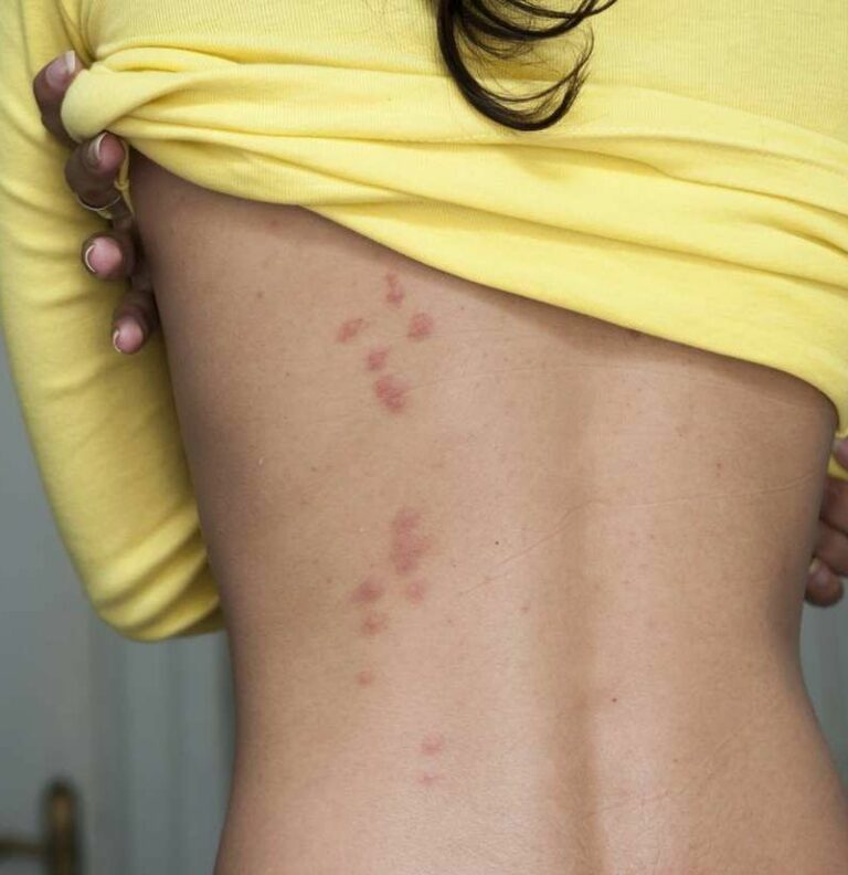 Piquetes de chinches: identificación y prevención eficaz