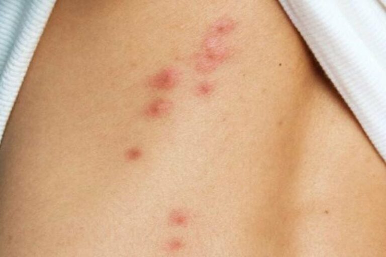 Porque las chinches no pican a todos: descubre por qué