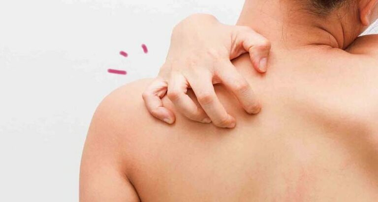 Qué pasa si te pican mucho las chinches de cama: síntomas y efectos